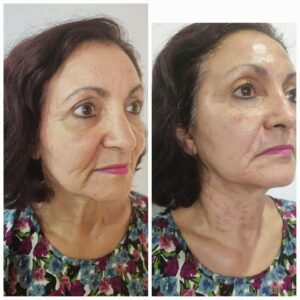 Ultherapy Treatment in Puerto Rico